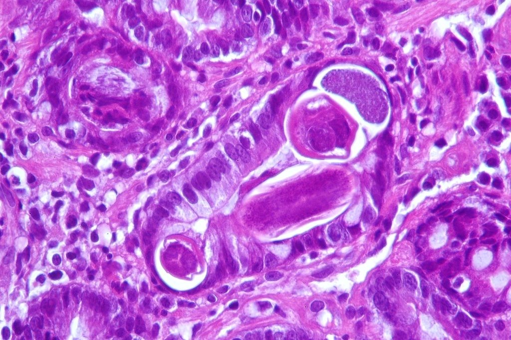 duodénite parasitaire